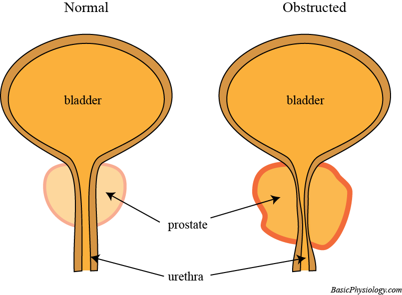 Effects of an enlarged prostate on the male urethra: obstruction