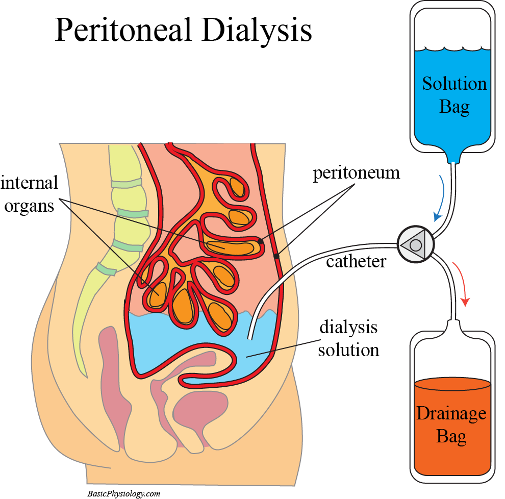 Diagram of peritoneal dialysis